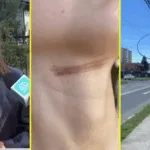 Municipio de Temuco acompaña a ciclista accidentada por cable en desuso y evalúa acciones legales